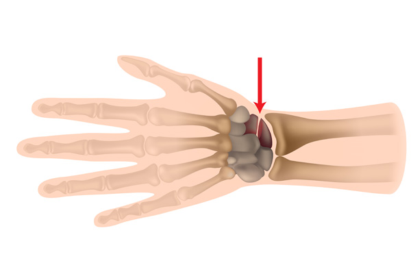 What are Scaphoid Fractures?