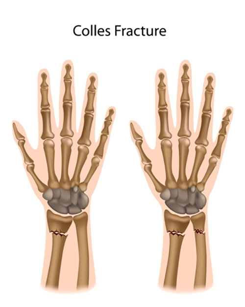 colles fracture wrist
